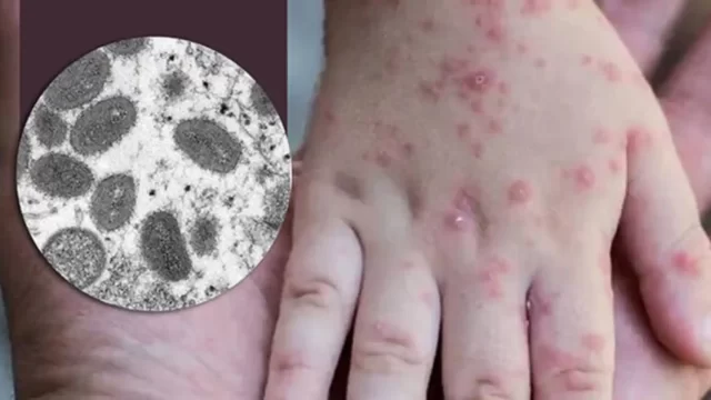 Noticias Chihuahua PAUSA.MX OMS reporta 14 mil casos de viruela del mono en el mundo