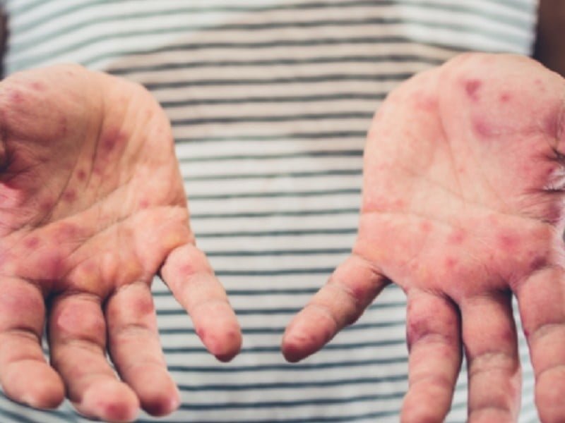 Virus de coxsackie ¿cuáles son los síntomas y cómo se contagia? Pausa MX Virus de coxsackie ¿cuáles son los síntomas y cómo se contagia? Pausa MX