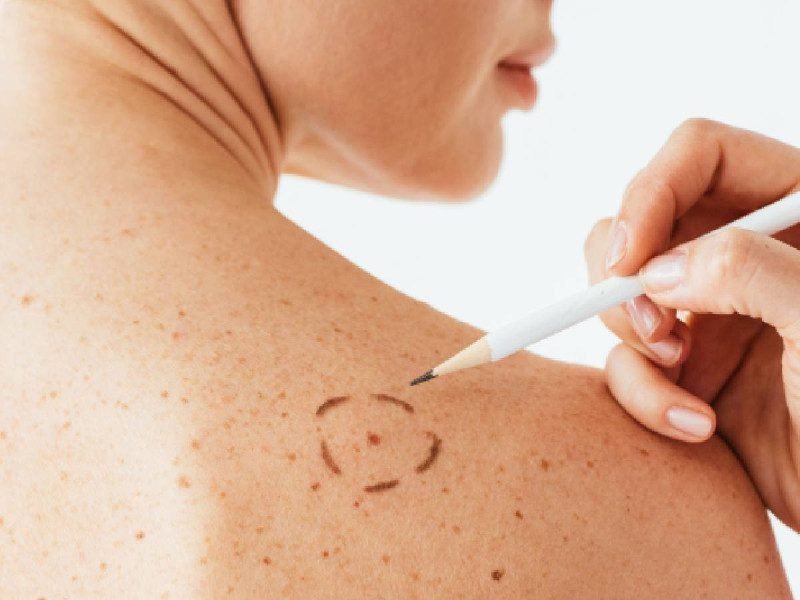 Nueva vacuna de Moderna reduce 49% riesgo de muerte por cáncer de piel