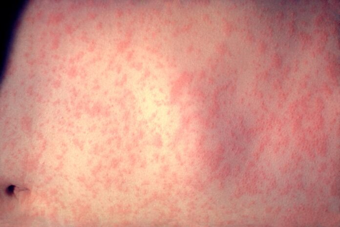 Morbillivirus_measles_infection