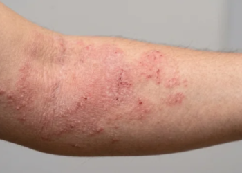 En México, 80% de los cuidadores de pacientes con dermatitis atópica reportan depresión En México, 80% de los cuidadores de pacientes con dermatitis atópica reportan depresión