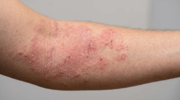 En México, 80% de los cuidadores de pacientes con dermatitis atópica reportan depresión
